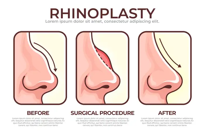 Top 6 Nose Shape Concerns That Can Find Resolution in Rhinoplasty